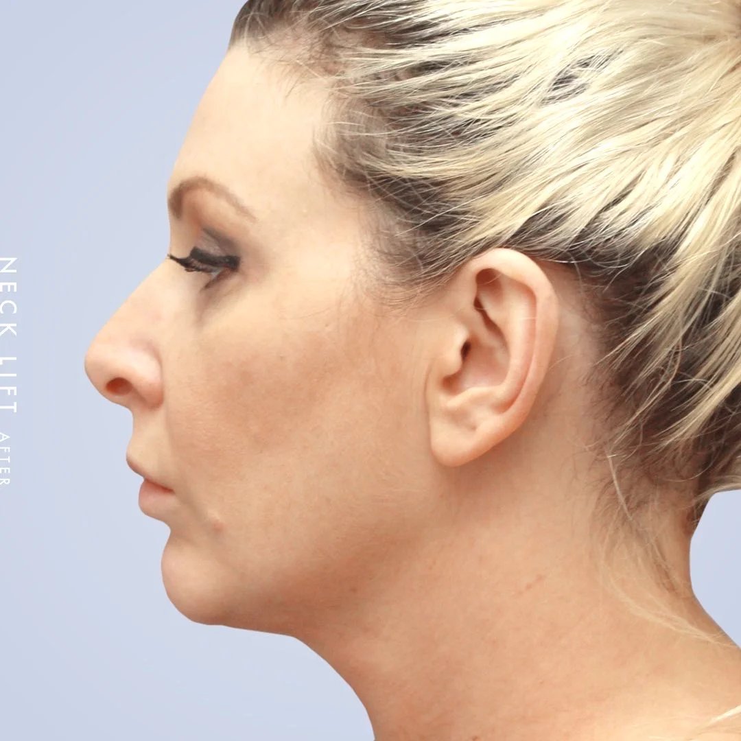 Face & Neck Before & After Gallery - Patient 117693229 - Image 2