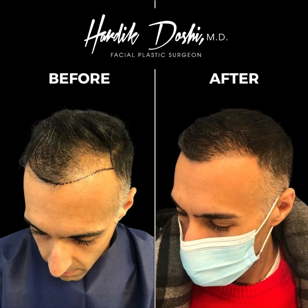 Hair Transplant in Long Island