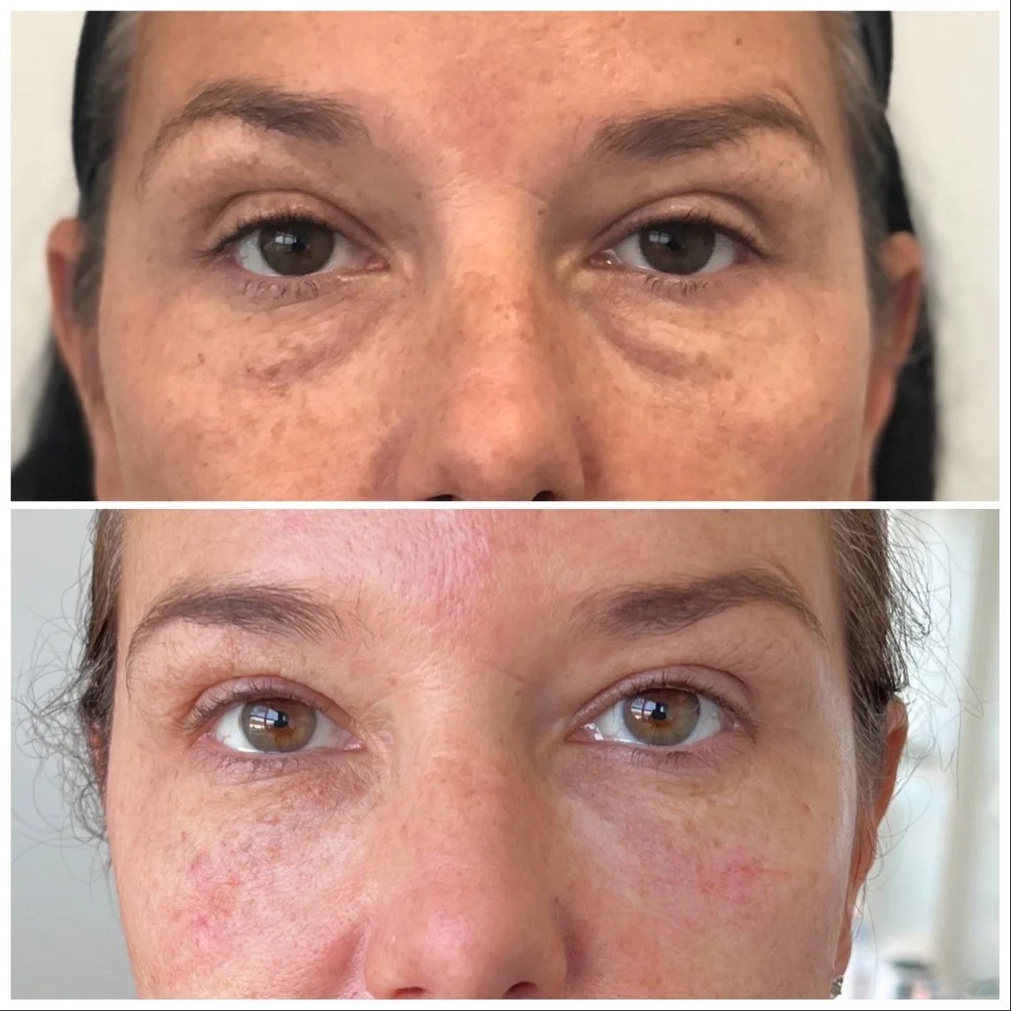 Non-Surgical Eyes Before & After Gallery - Patient 121439069 - Image 1