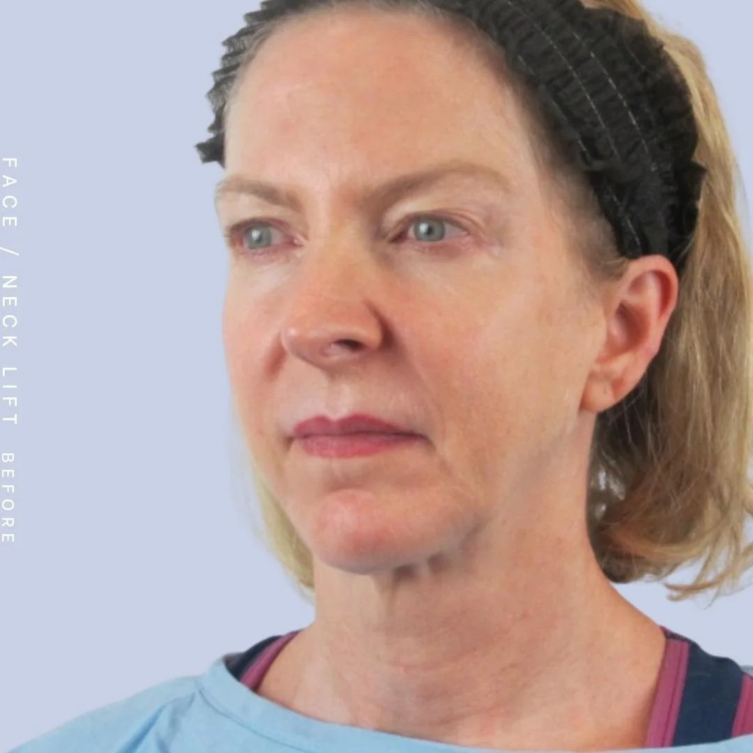 Face & Neck Before & After Gallery - Patient 120868608 - Image 7