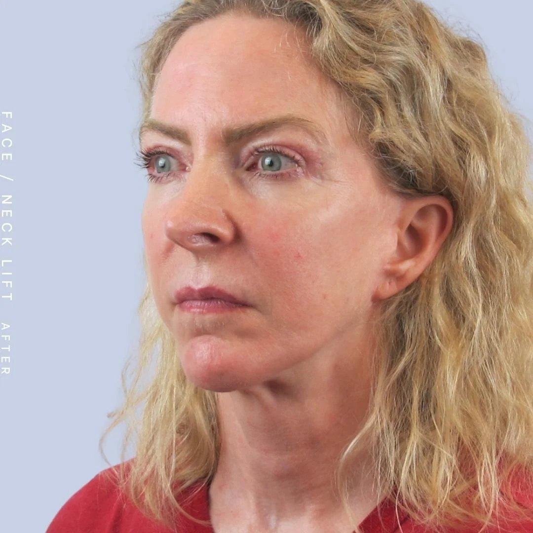 Face & Neck Before & After Gallery - Patient 120868608 - Image 8