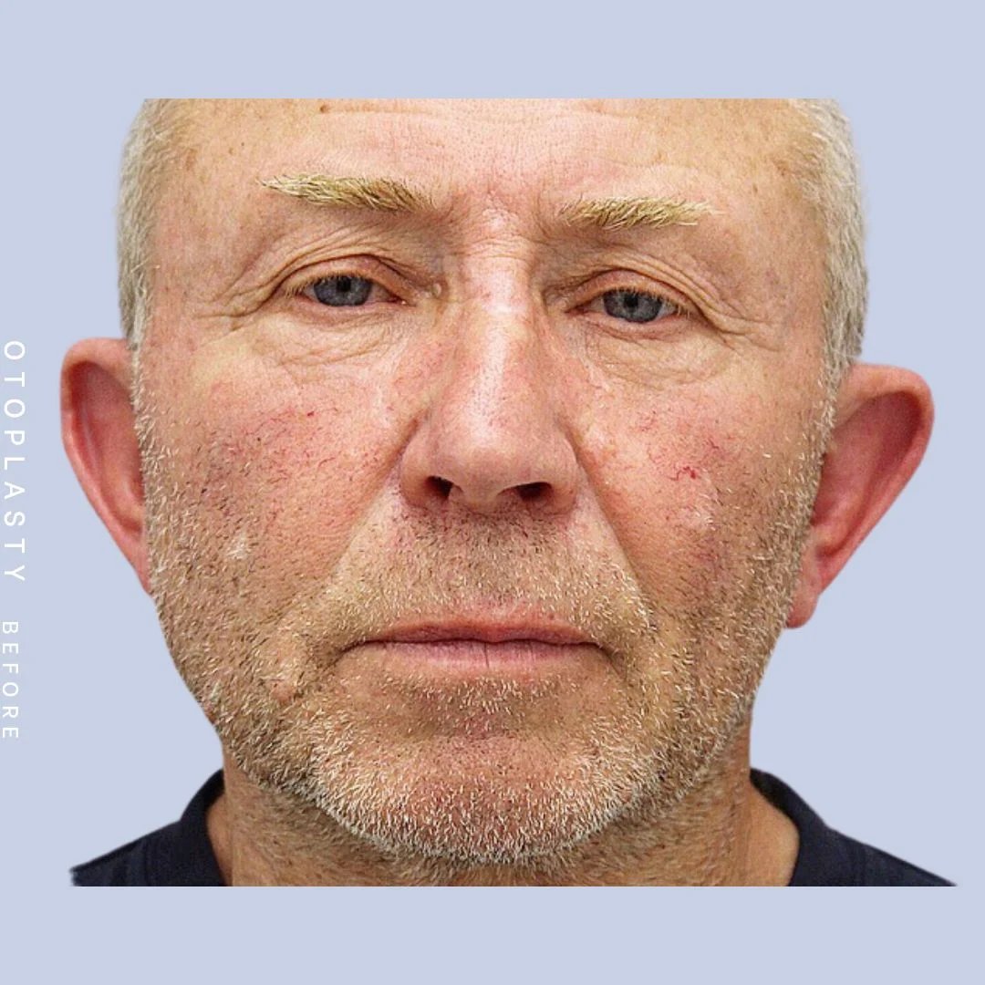 Ears Before & After Gallery - Patient 108744089 - Image 1