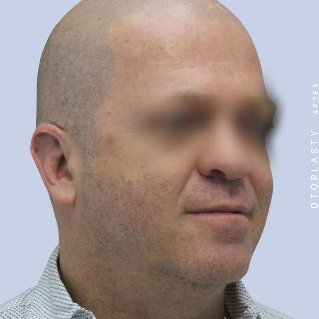 Ears Before & After Gallery - Patient 120868401 - Image 8