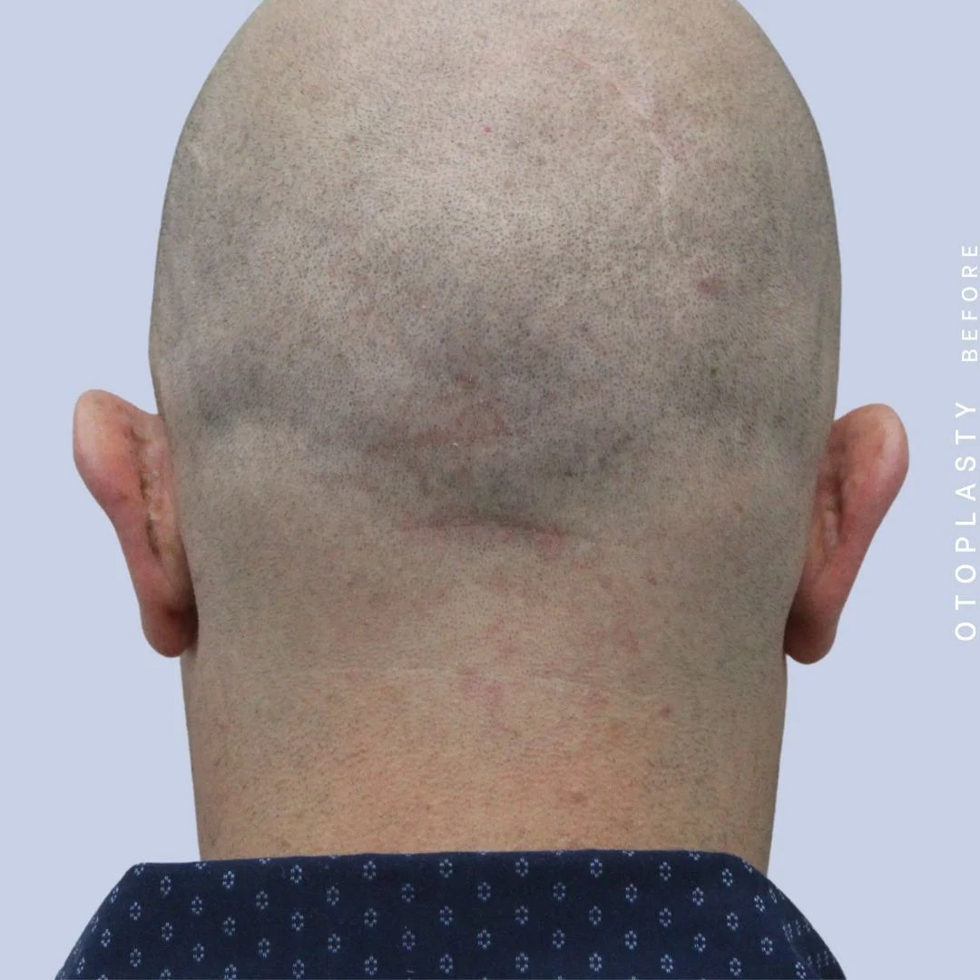 Ears Before & After Gallery - Patient 120868401 - Image 11