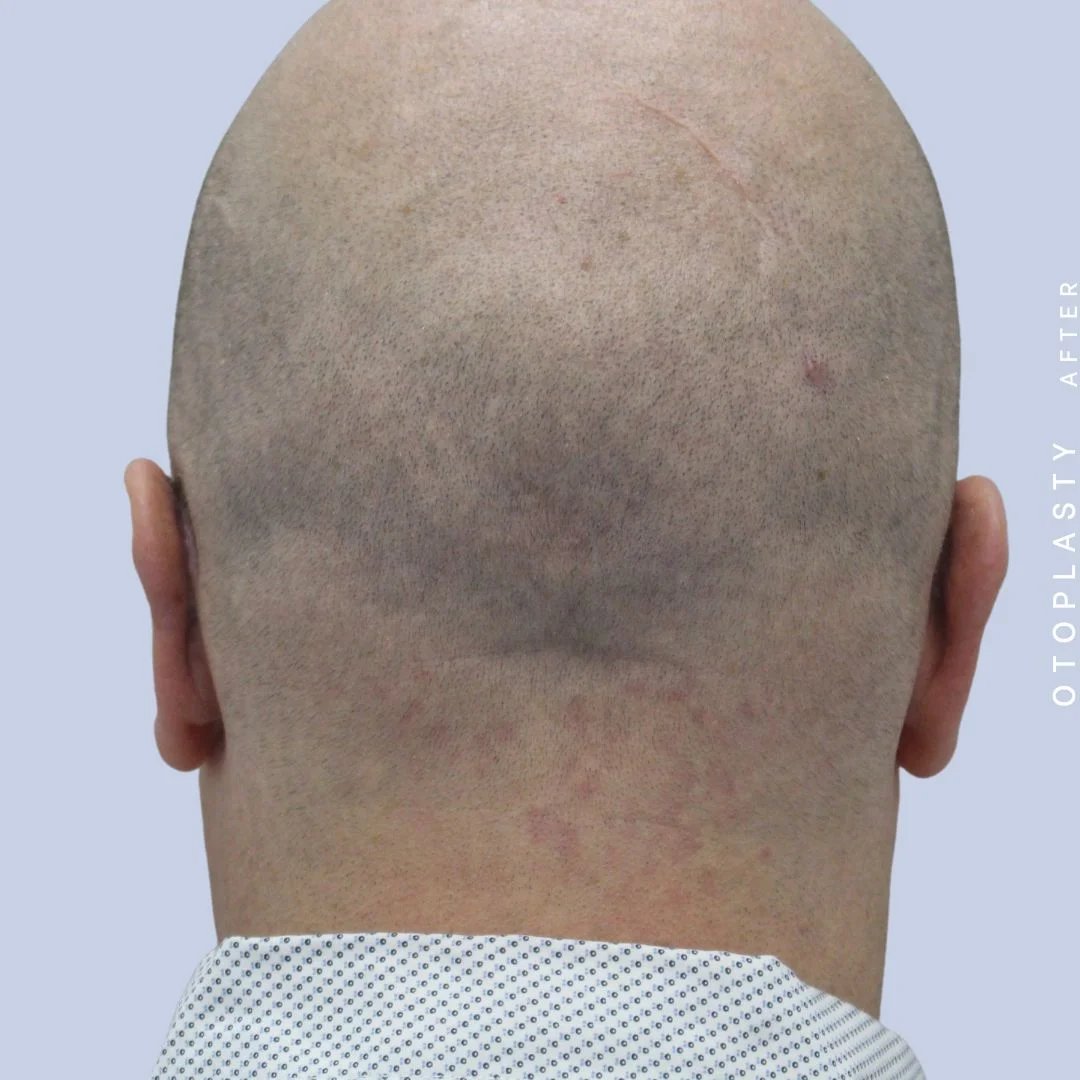 Ears Before & After Gallery - Patient 120868401 - Image 12