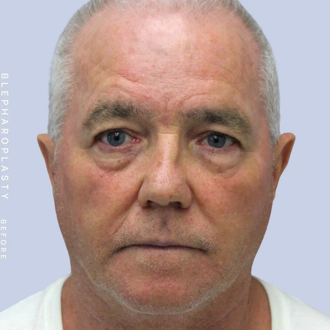 Men's Eyes Before & After Gallery - Patient 108764323 - Image 1