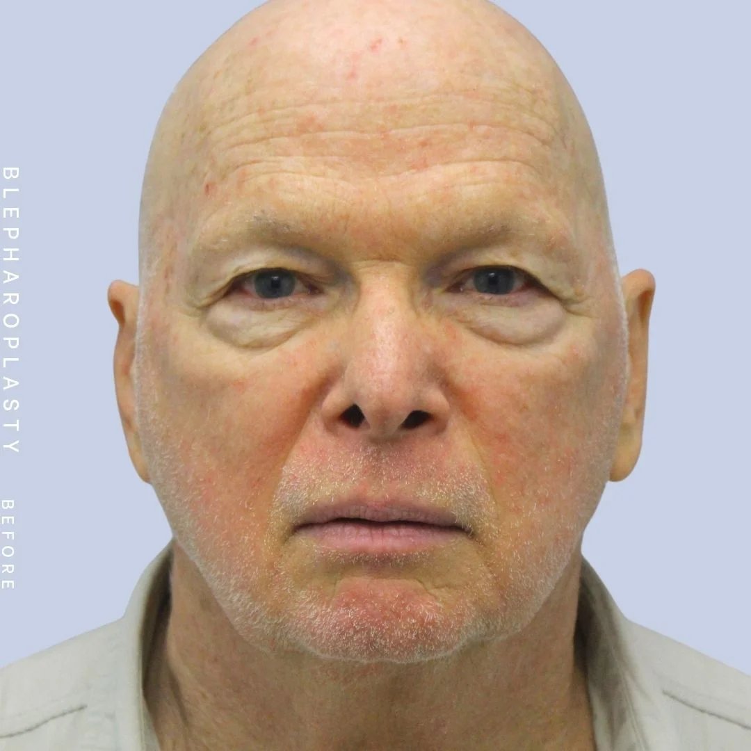 Men's Eyes Before & After Gallery - Patient 108764324 - Image 1