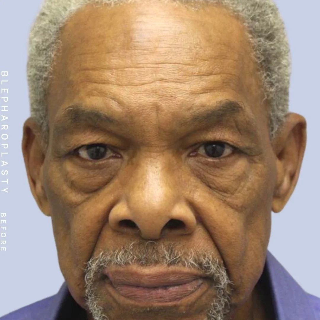 Men's Eyes Before & After Gallery - Patient 120868205 - Image 1