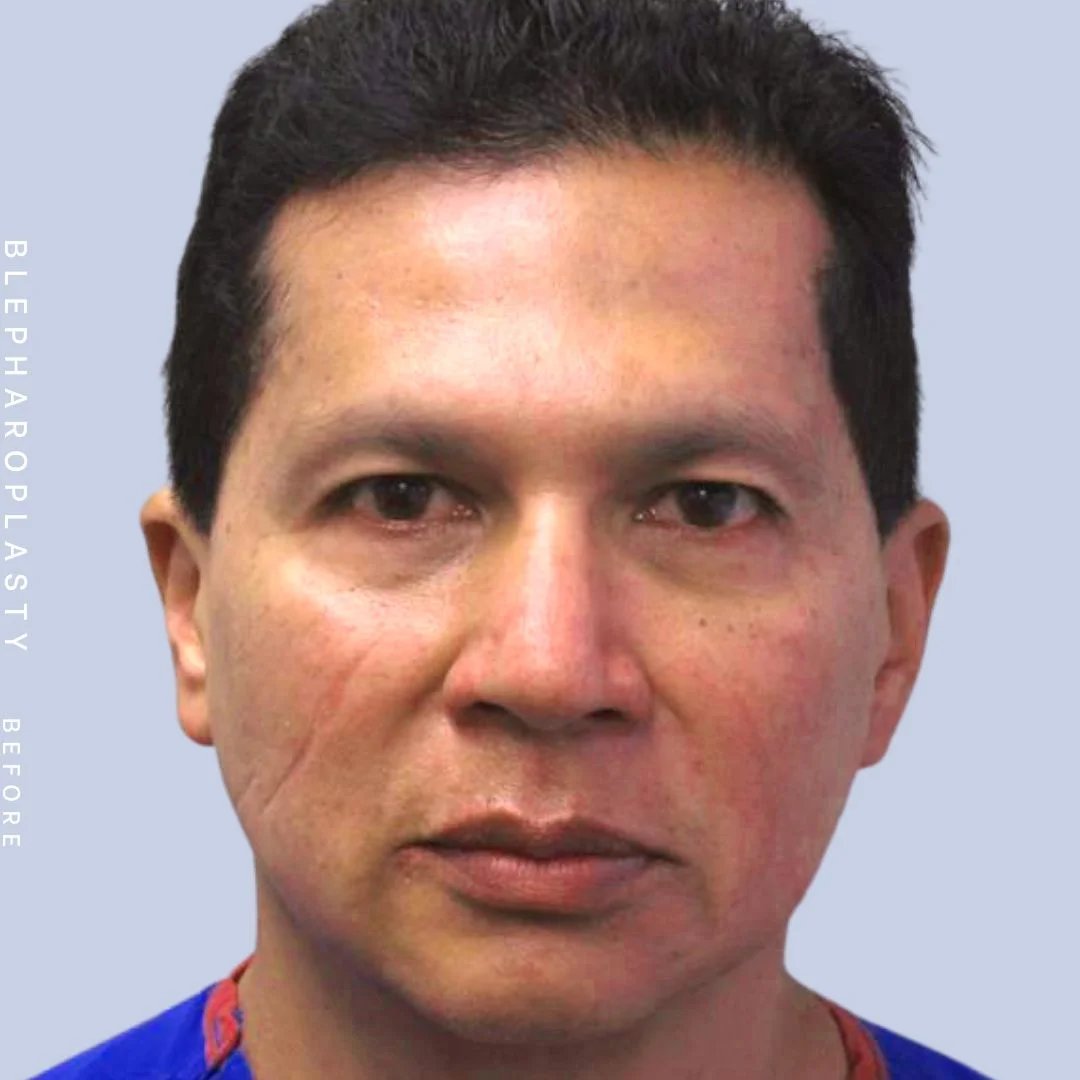 Men's Eyes Before & After Gallery - Patient 121500240 - Image 1