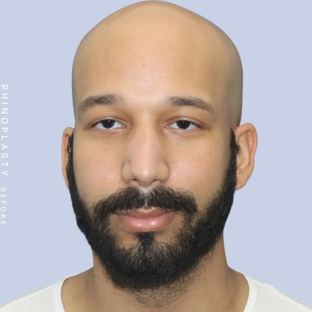 Men's Nose Before & After Gallery - Patient 108763901 - Image 1