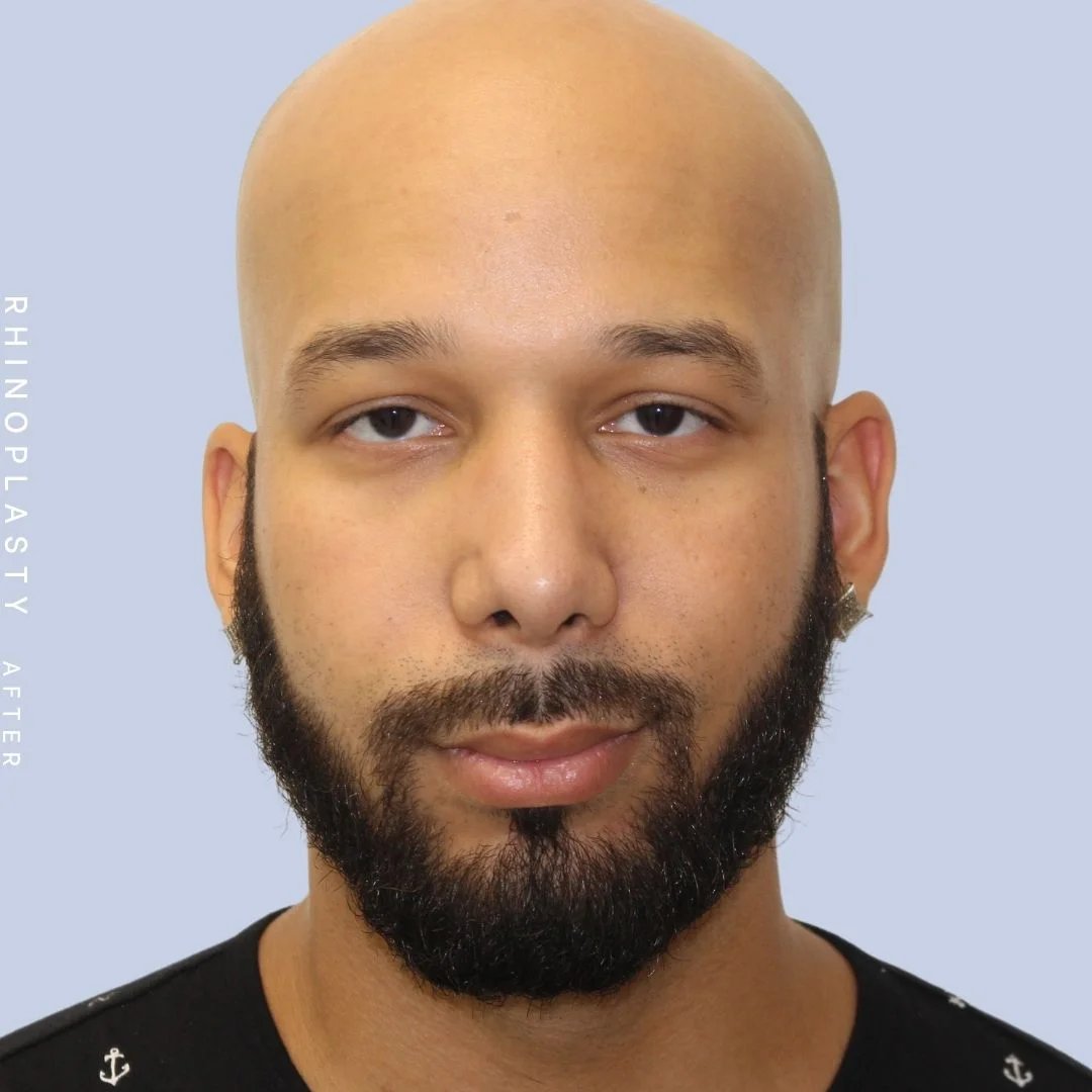 Men's Nose Before & After Gallery - Patient 108763901 - Image 2