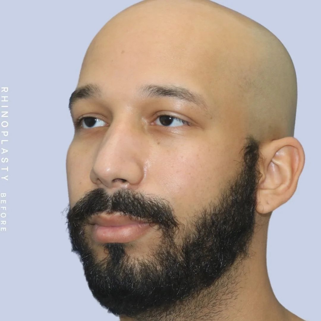 Men's Nose Before & After Gallery - Patient 108763901 - Image 3