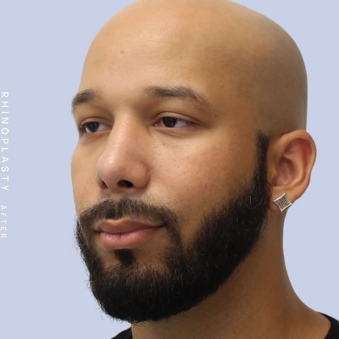 Men's Nose Before & After Gallery - Patient 108763901 - Image 4