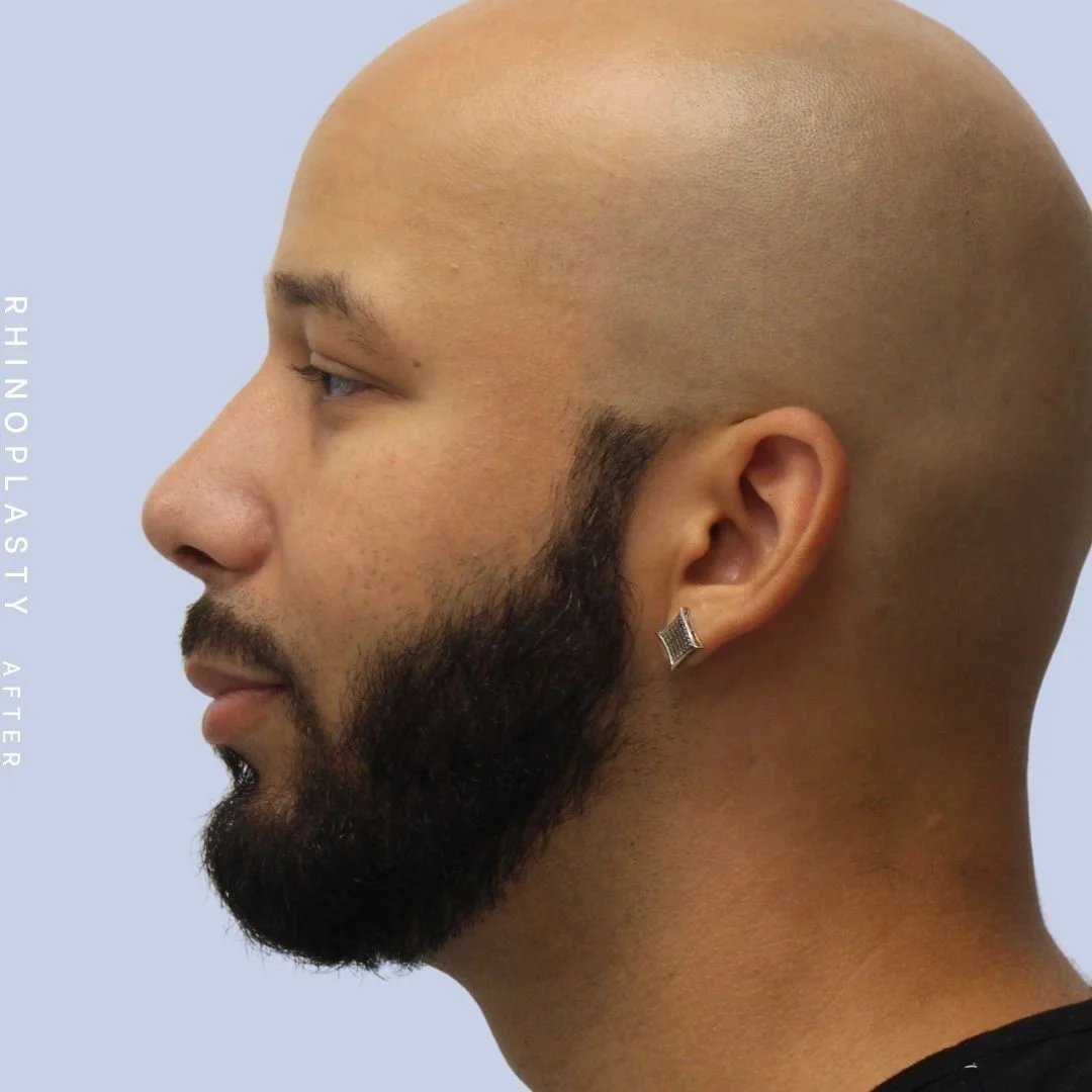 Men's Nose Before & After Gallery - Patient 108763901 - Image 6