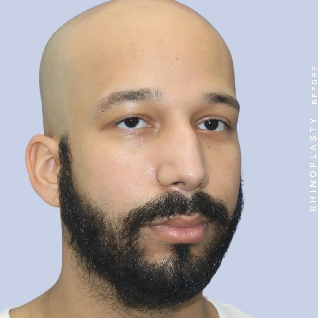 Men's Nose Before & After Gallery - Patient 108763901 - Image 7