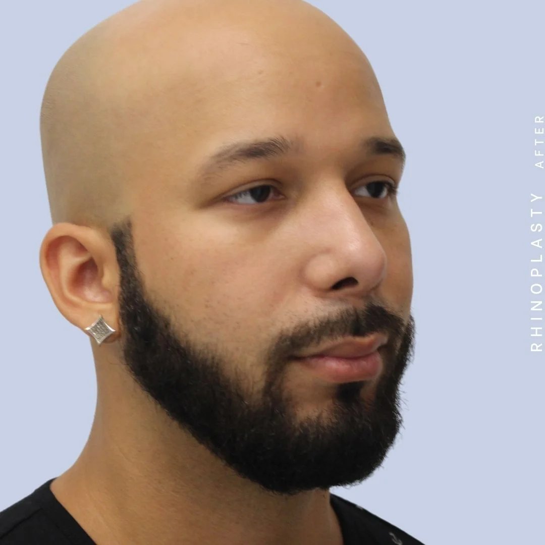 Men's Nose Before & After Gallery - Patient 108763901 - Image 8