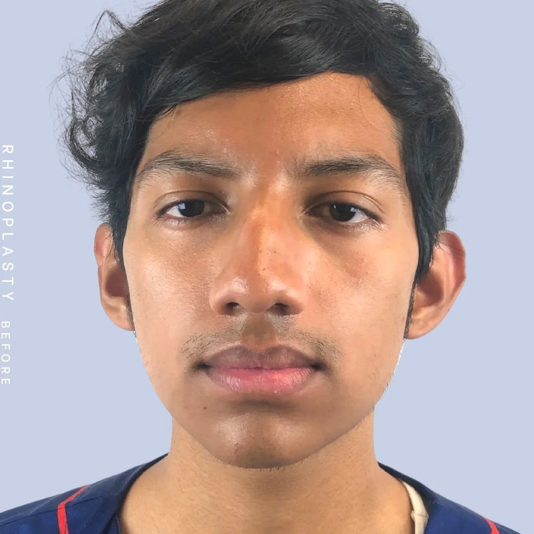 Men's Nose Before & After Gallery - Patient 108763902 - Image 1
