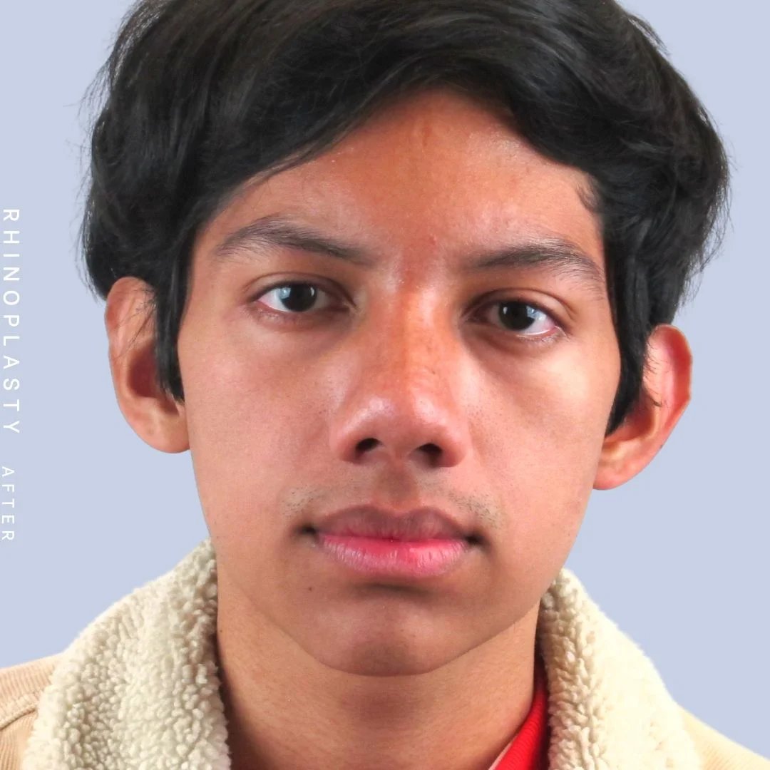 Men's Nose Before & After Gallery - Patient 108763902 - Image 2