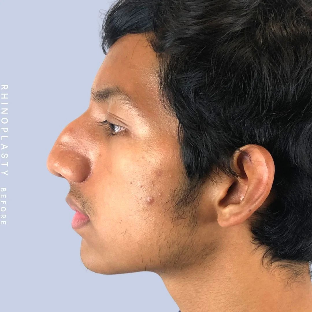 Men's Nose Before & After Gallery - Patient 108763902 - Image 3