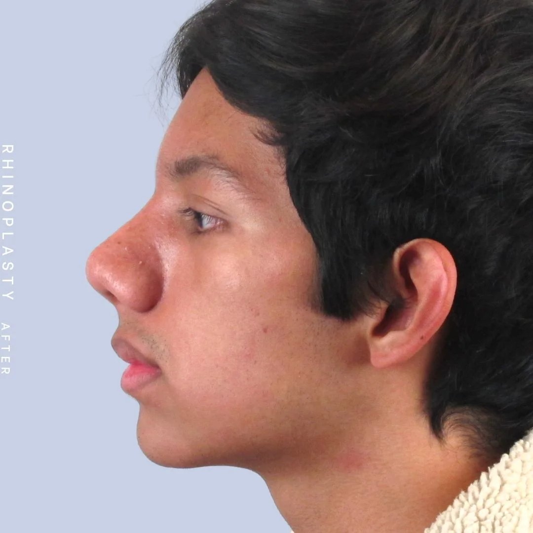 Men's Nose Before & After Gallery - Patient 108763902 - Image 4