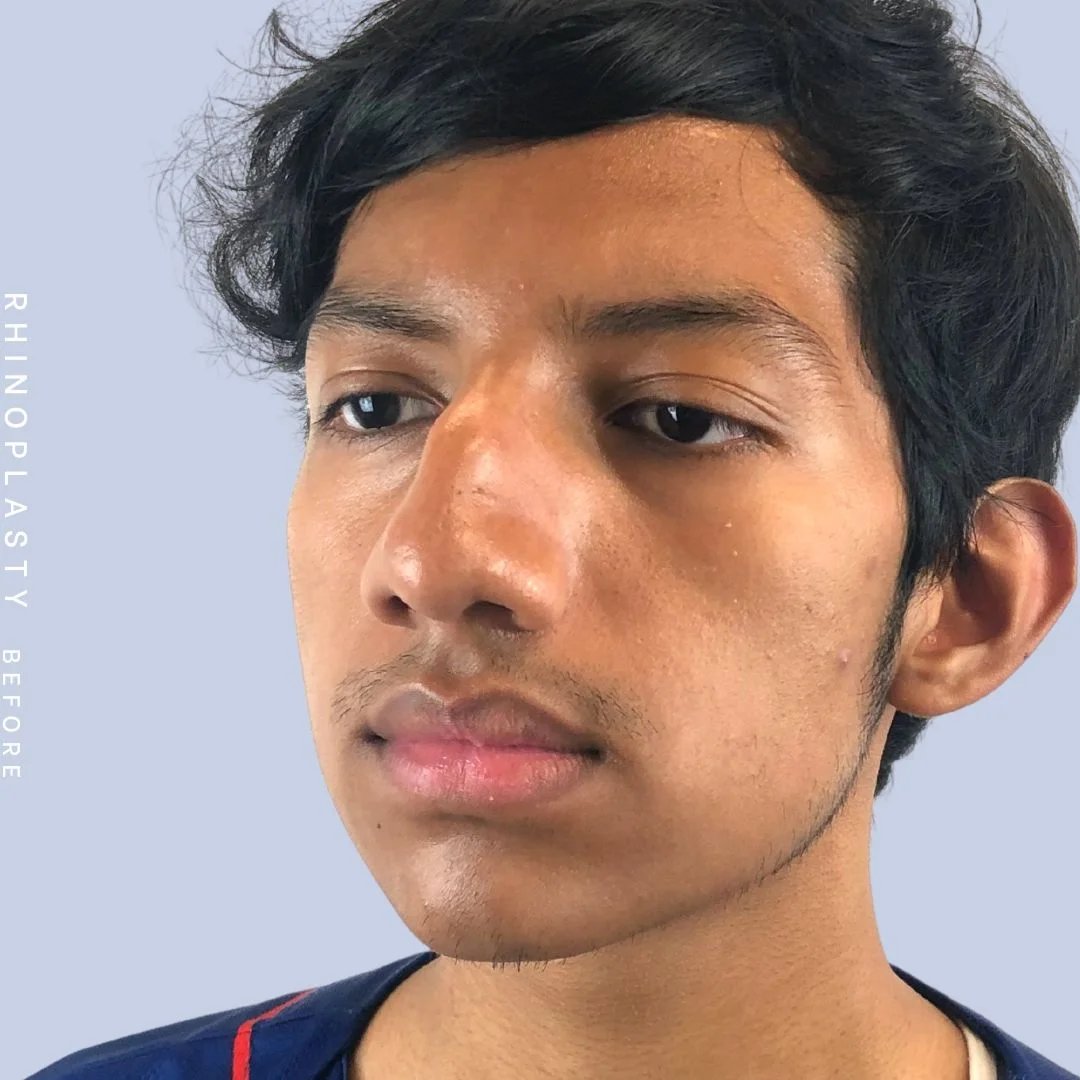 Men's Nose Before & After Gallery - Patient 108763902 - Image 5