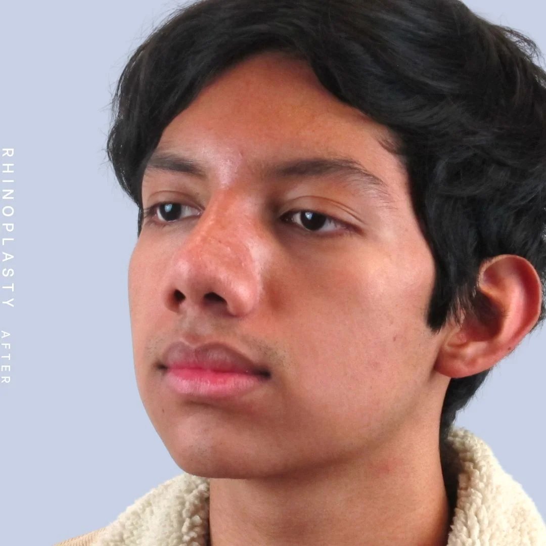 Men's Nose Before & After Gallery - Patient 108763902 - Image 6