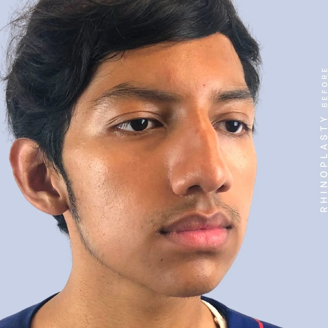 Men's Nose Before & After Gallery - Patient 108763902 - Image 7