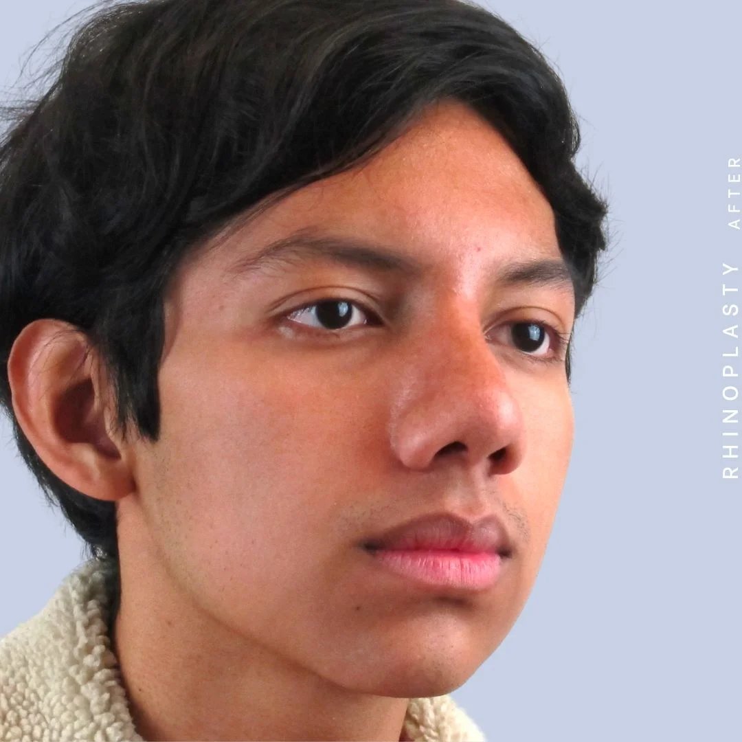 Men's Nose Before & After Gallery - Patient 108763902 - Image 8