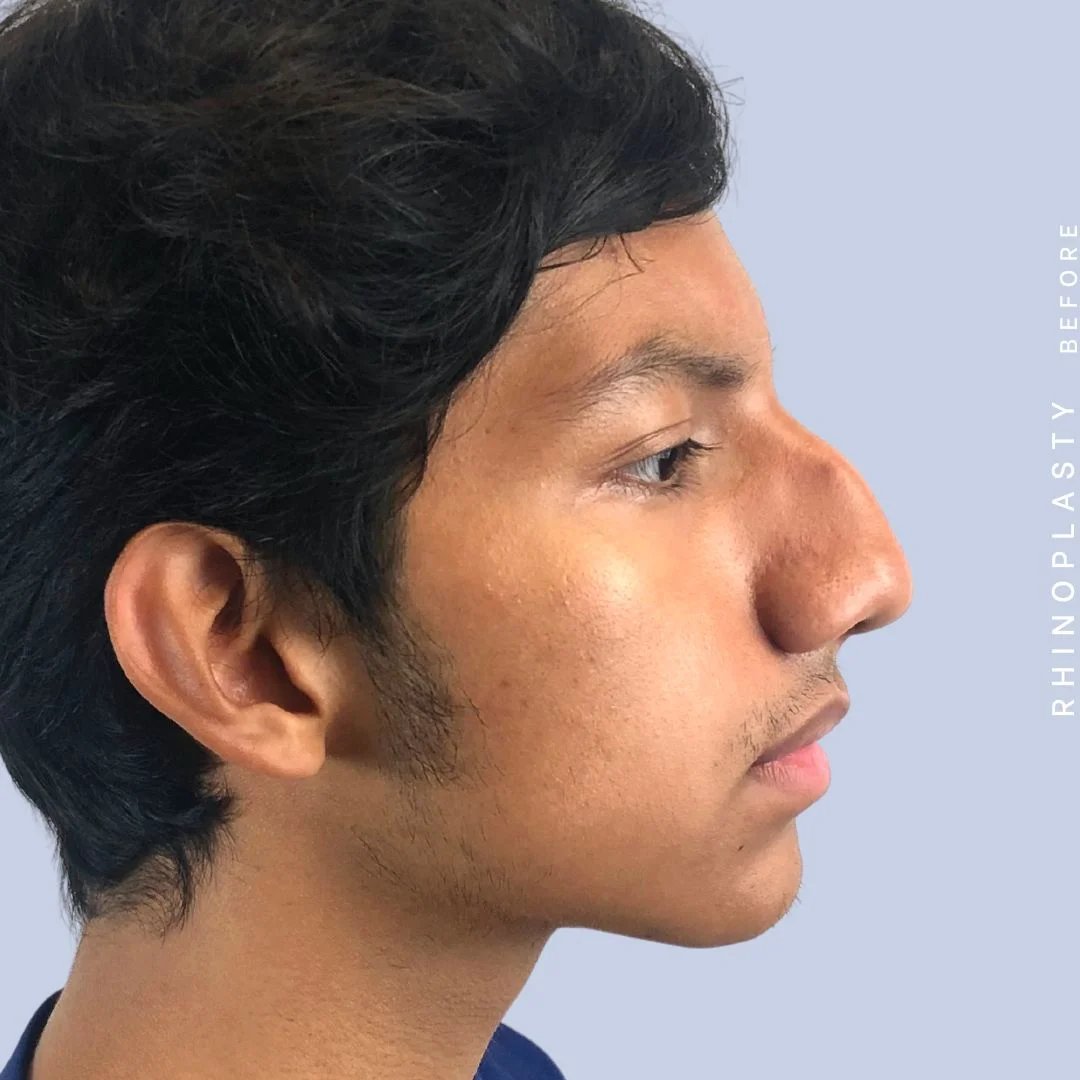 Men's Nose Before & After Gallery - Patient 108763902 - Image 9