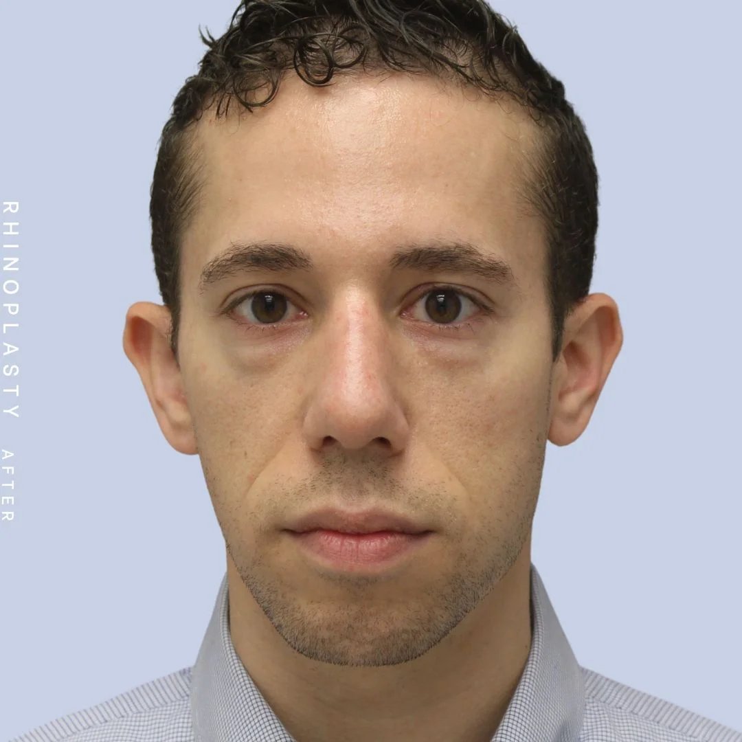 Men's Nose Before & After Gallery - Patient 108763903 - Image 2