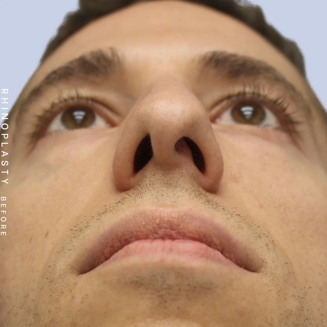 Men's Nose Before & After Gallery - Patient 108763903 - Image 3