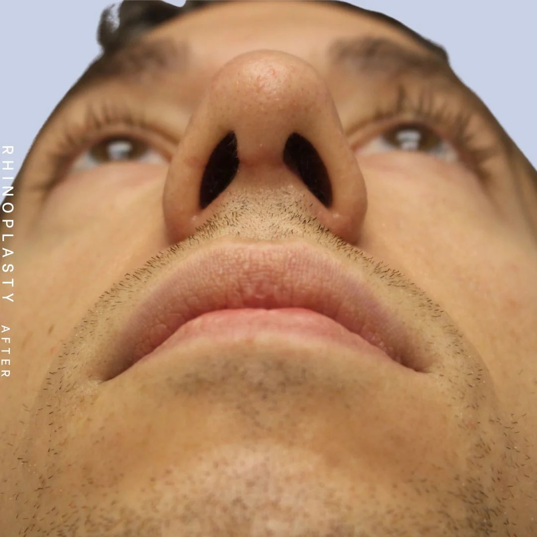 Men's Nose Before & After Gallery - Patient 108763903 - Image 4