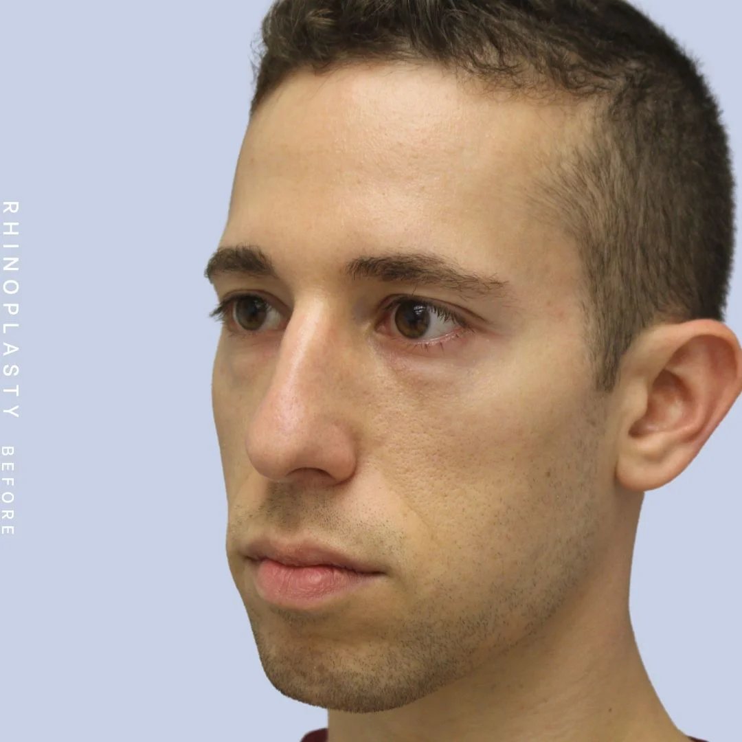 Men's Nose Before & After Gallery - Patient 108763903 - Image 5