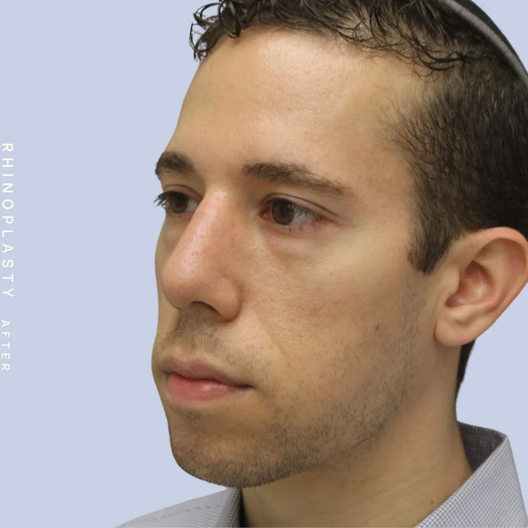Men's Nose Before & After Gallery - Patient 108763903 - Image 6