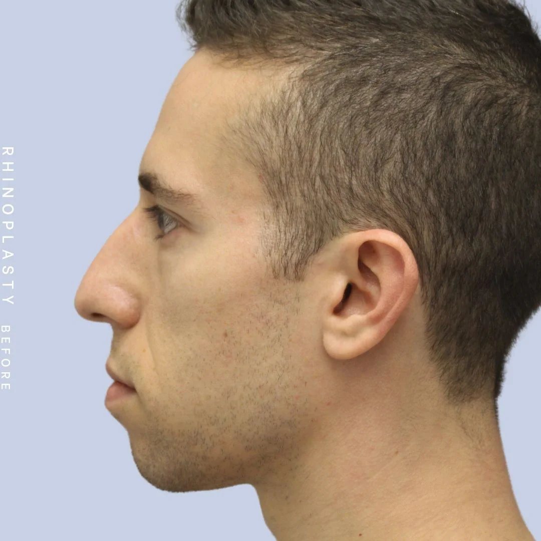 Men's Nose Before & After Gallery - Patient 108763903 - Image 7