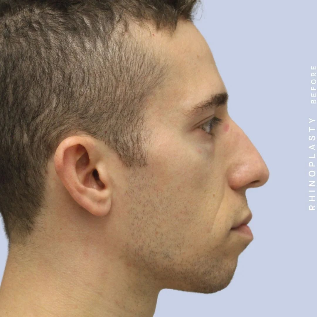Men's Nose Before & After Gallery - Patient 108763903 - Image 9