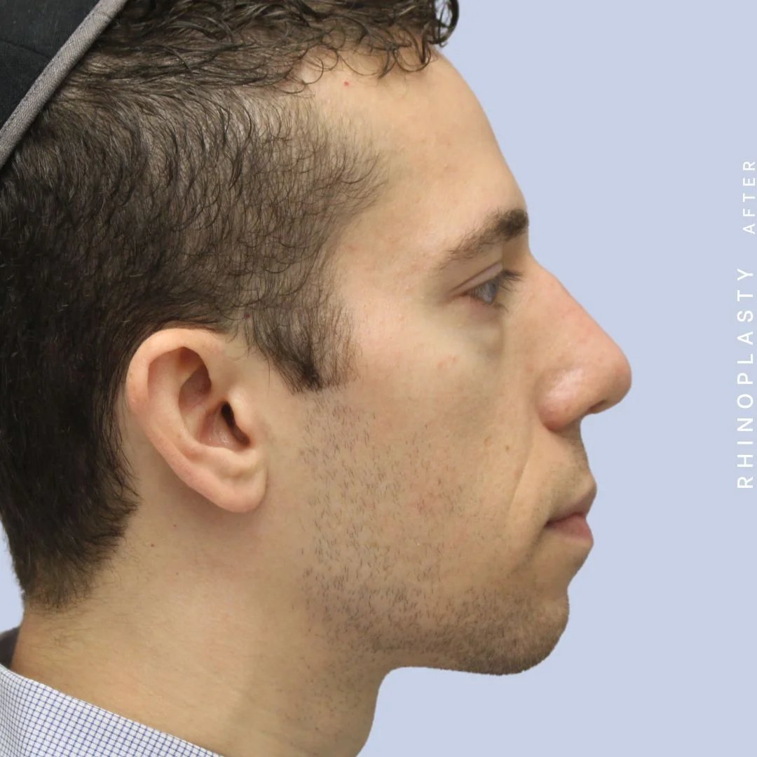 Men's Nose Before & After Gallery - Patient 108763903 - Image 10