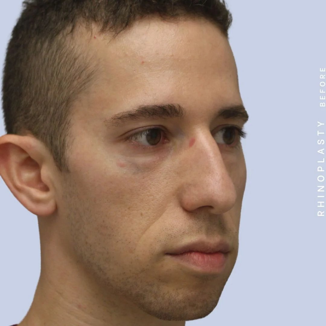 Men's Nose Before & After Gallery - Patient 108763903 - Image 11