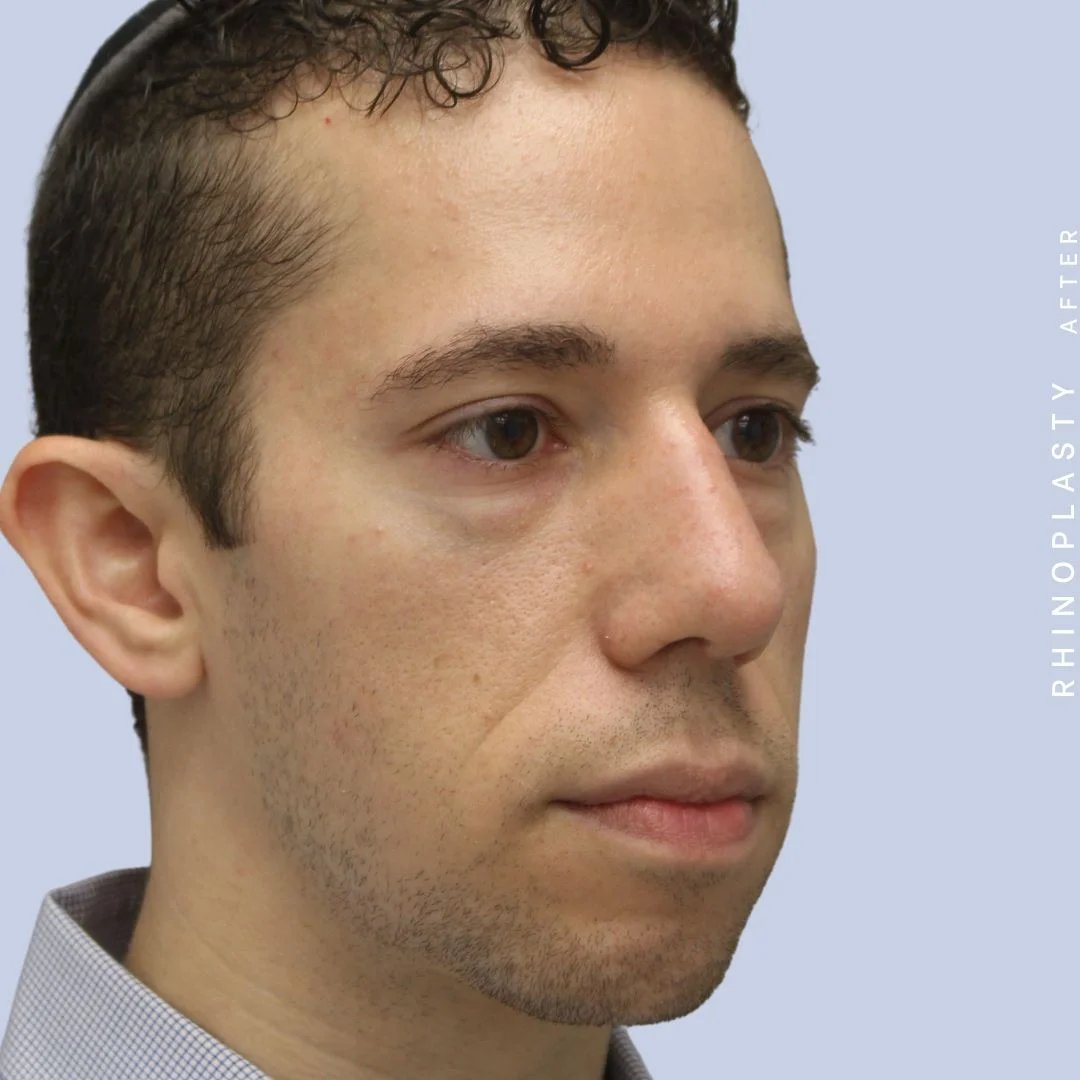 Men's Nose Before & After Gallery - Patient 108763903 - Image 12