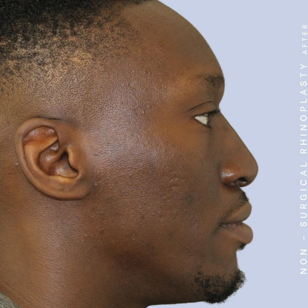 Men's Nose Before & After Gallery - Patient 108763904 - Image 4