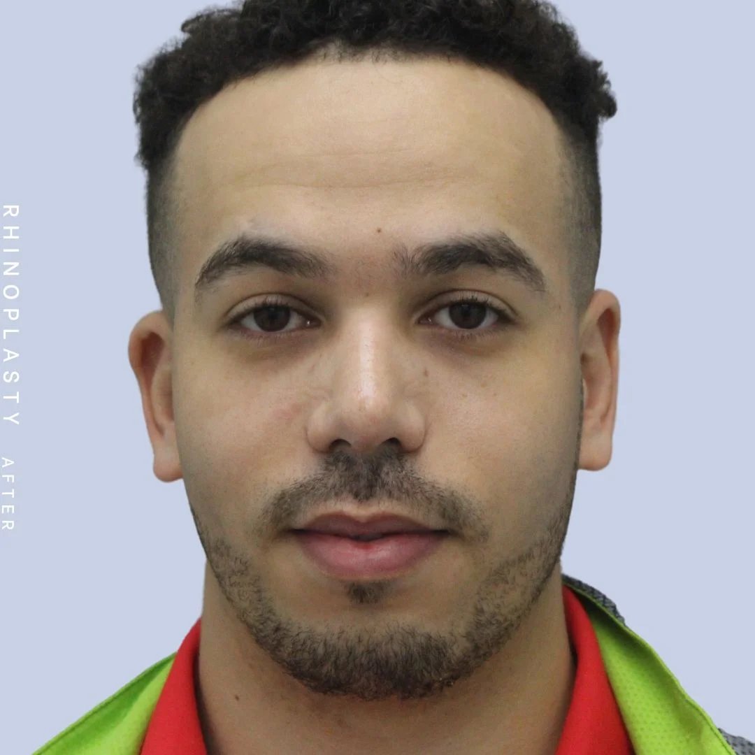 Men's Nose Before & After Gallery - Patient 120868232 - Image 2