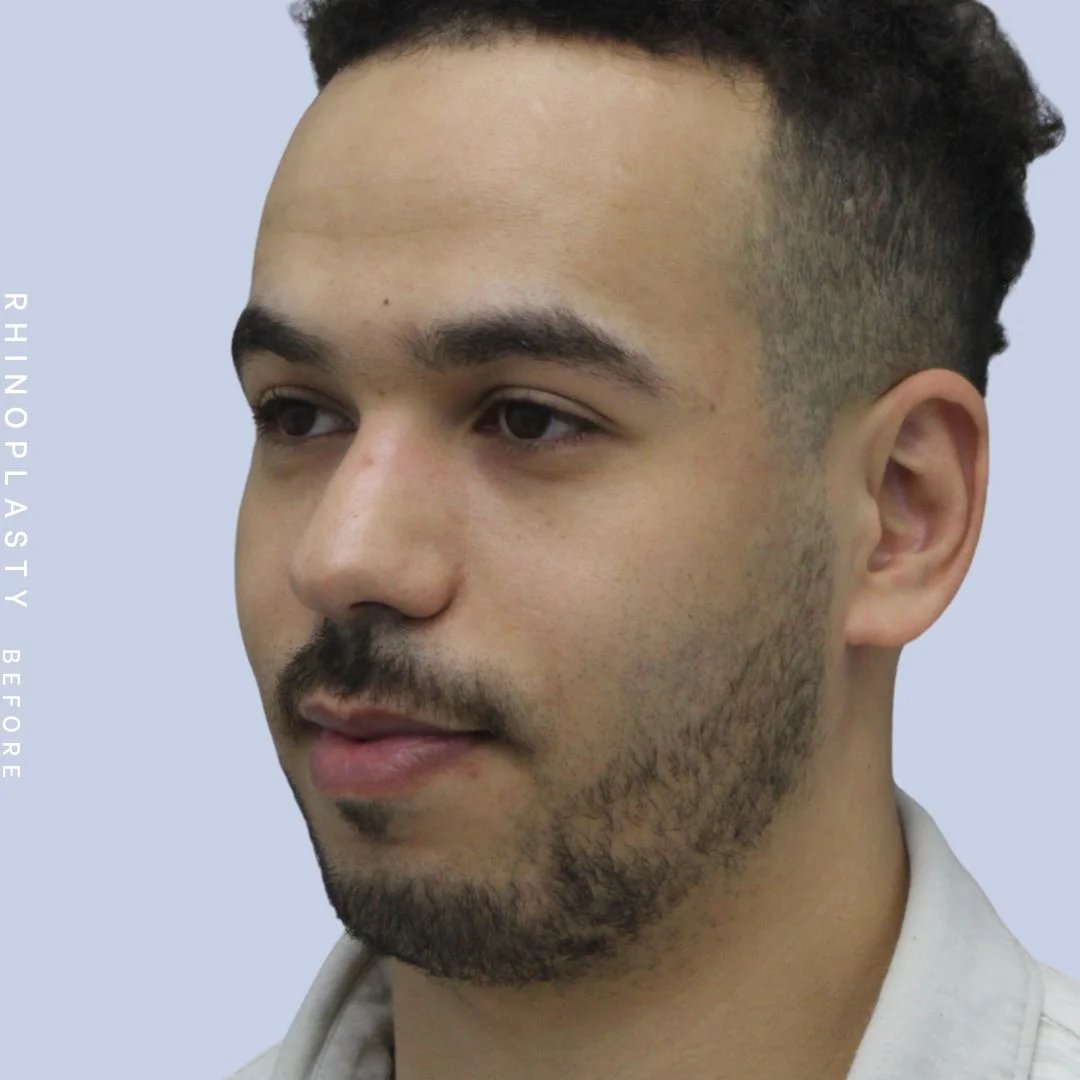 Men's Nose Before & After Gallery - Patient 120868232 - Image 3