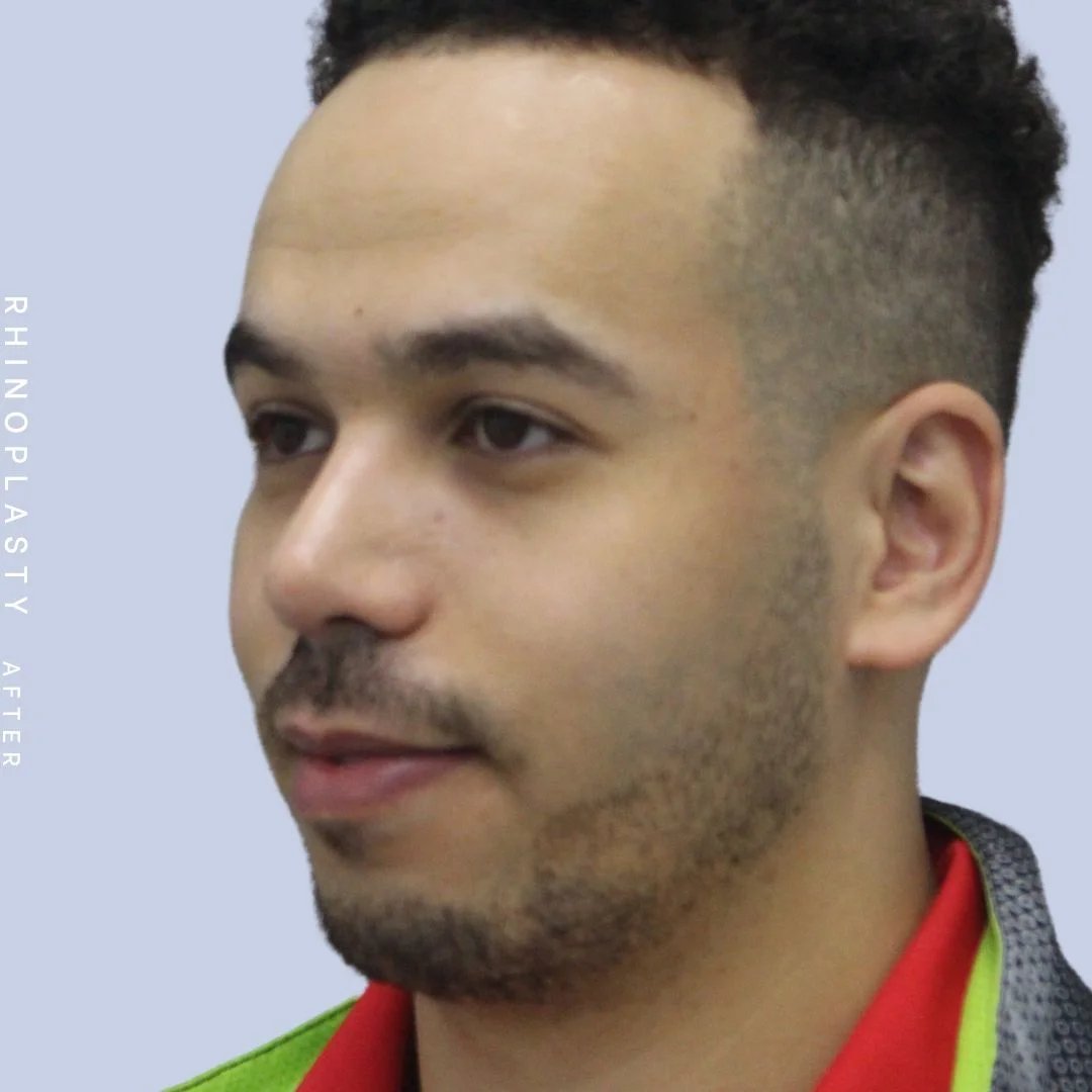 Men's Nose Before & After Gallery - Patient 120868232 - Image 4