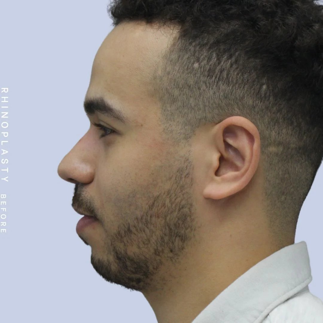 Men's Nose Before & After Gallery - Patient 120868232 - Image 5