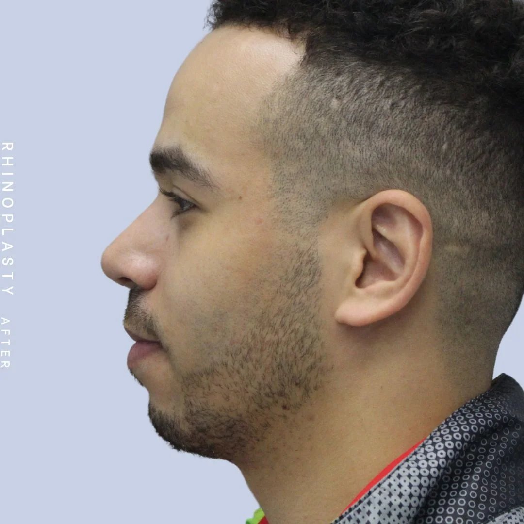 Men's Nose Before & After Gallery - Patient 120868232 - Image 6
