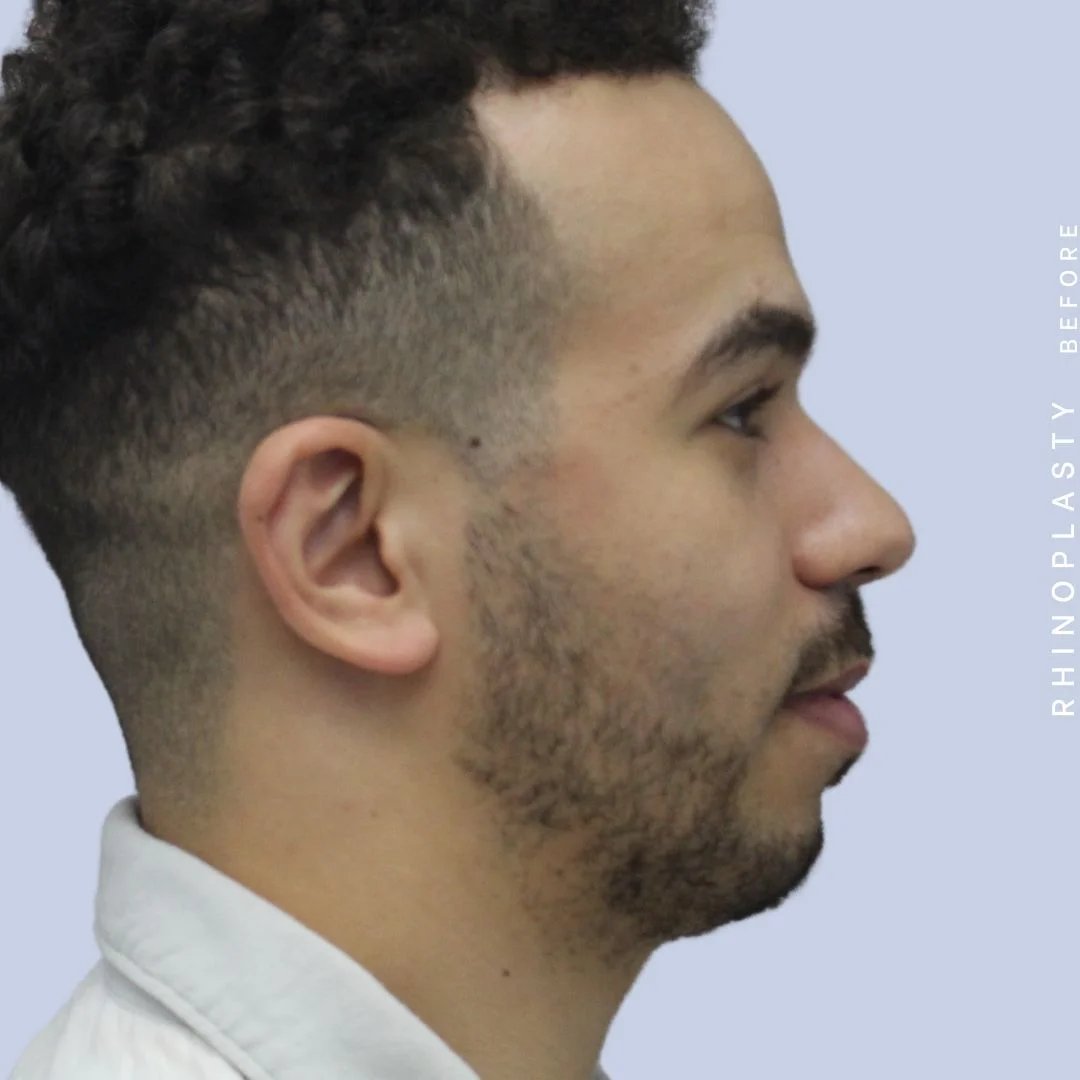 Men's Nose Before & After Gallery - Patient 120868232 - Image 7