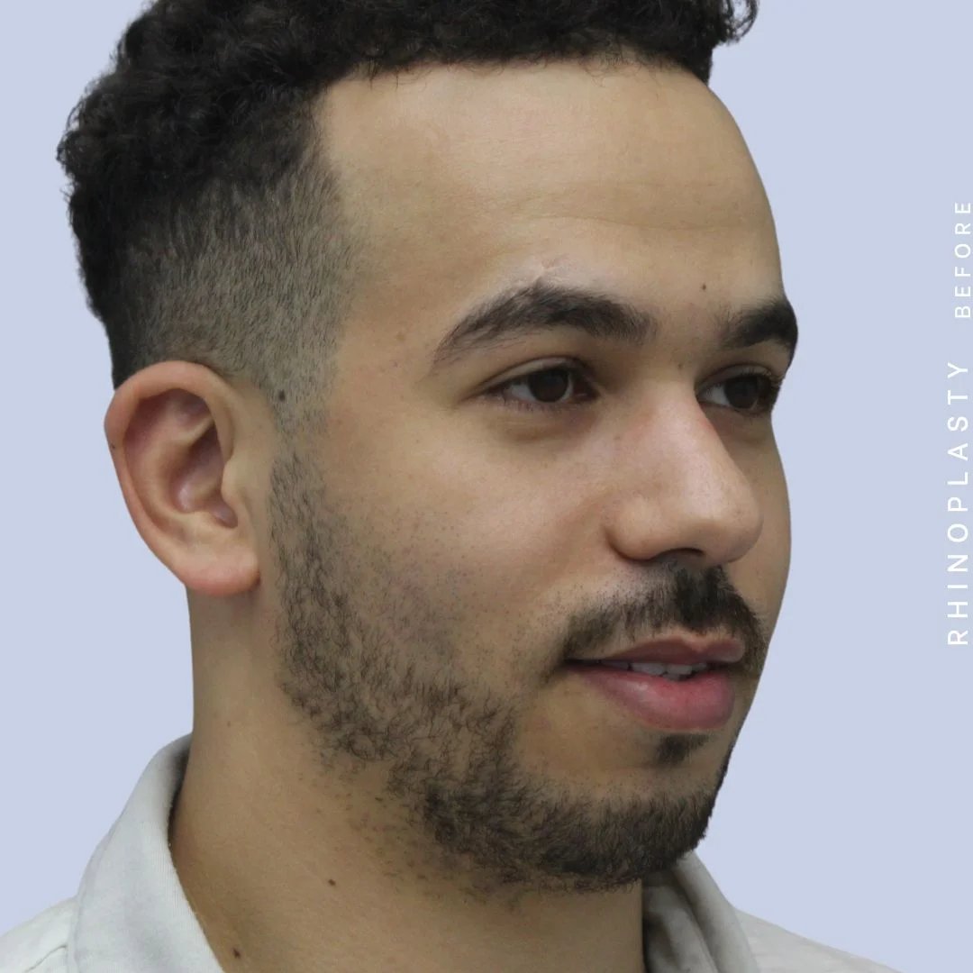 Men's Nose Before & After Gallery - Patient 120868232 - Image 9