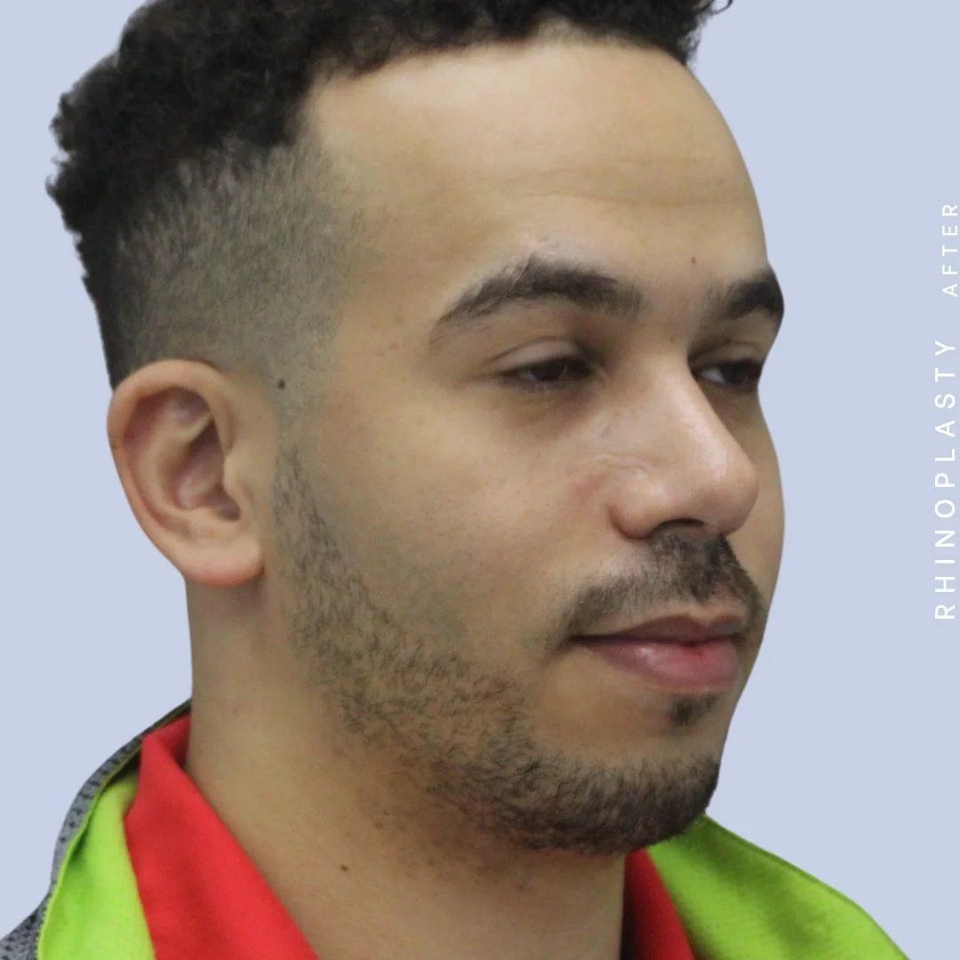 Men's Nose Before & After Gallery - Patient 120868232 - Image 10