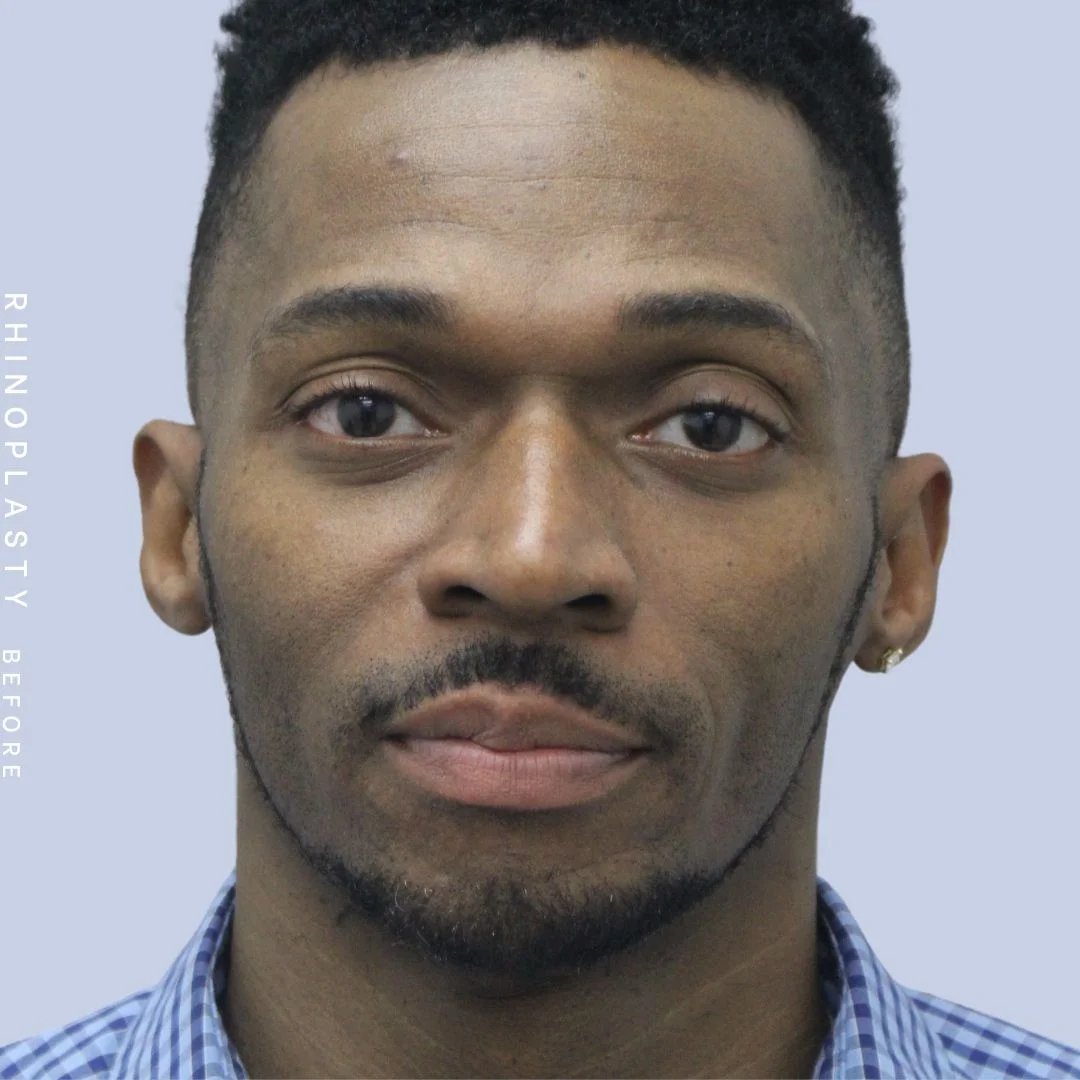 Men's Nose Before & After Gallery - Patient 120868322 - Image 1