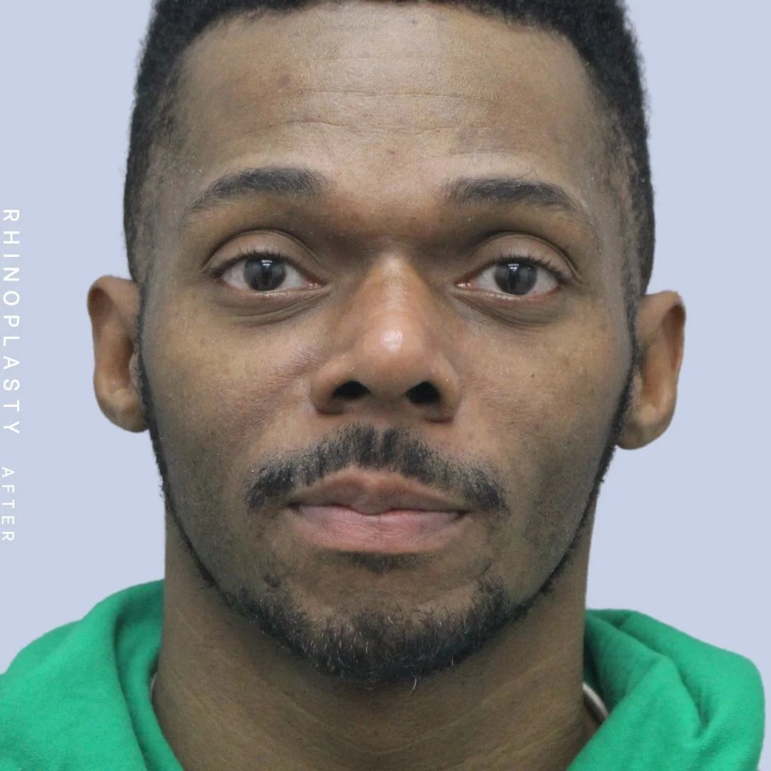 Men's Nose Before & After Gallery - Patient 120868322 - Image 2